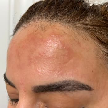 Batman Burak Gross Market’ten Satın Alınan Son Kullanma Tarihi Geçmiş Pantene Şampuan Seti Nedeniyle Saç Dökülmesi Ve Kimyasal Yanık