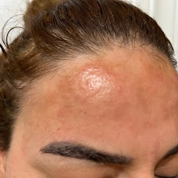 Batman Burak Gross Market’ten Satın Alınan Son Kullanma Tarihi Geçmiş Pantene Şampuan Seti Nedeniyle Saç Dökülmesi Ve Kimyasal Yanık