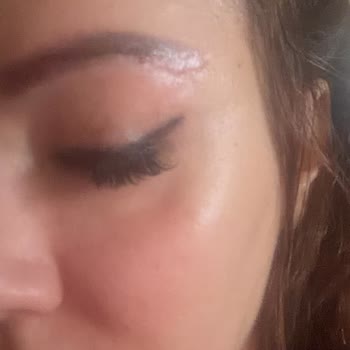 Apex Tıp Merkezi'nde Yanıltıcı Bilgiyle Yapılan Göz Kapağı Ameliyatı Sonrası Kalıcı İz