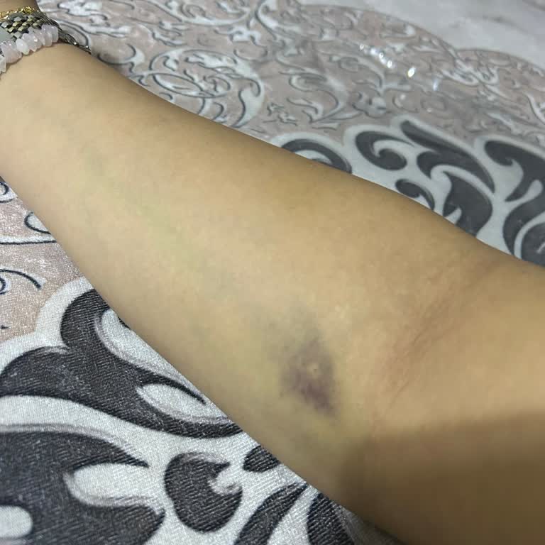 İpek Yolu Sağlık Ocağında Stajyer Çalışanın Yanlış Kan Alma İşlemi Kolumda Şiddetli Morarma Yarattı