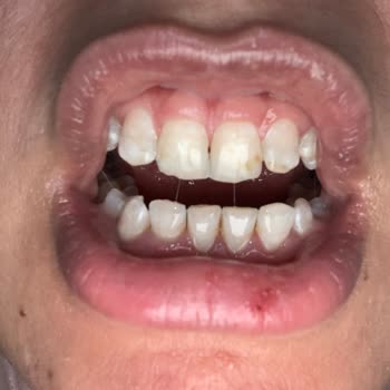 Diş Beyazlatma Cihazının Kullanımında Ağrı Ve Sararma, 14 Gün Sonrası İade Reddi