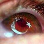 Caner